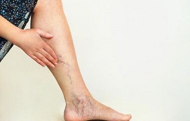 Πώς να θεραπεύσετε τις κιρσοί των κάτω άκρων