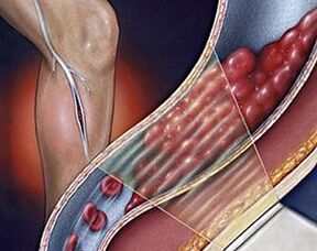 κιρσοί των βαθιών φλεβών των κάτω άκρων